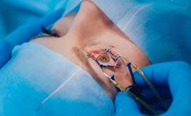Easy LASIK Eye Surgery in Faridabad at Eye Roots
