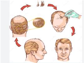 hair transplantation in  prayagraj , uttar pradesh