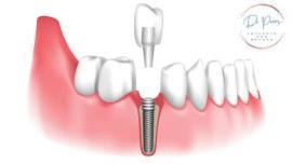 All on 4 dental implants cost